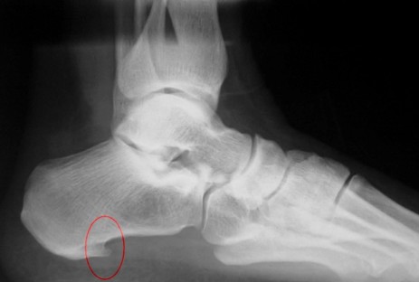 manejo de fascitis con ondas de choque