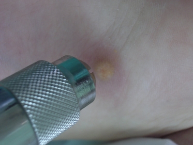 Dermojet manejo por podologo bogota