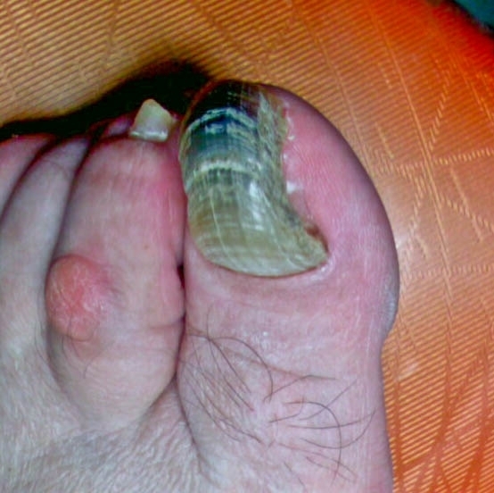 uña gruesa, uña deforme, onicogrifosis