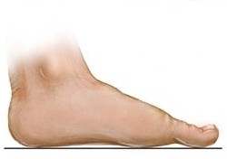 manejo del pie plano