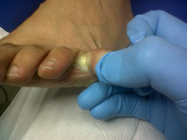 callo blando