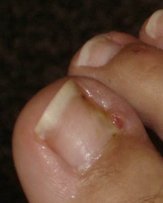 uña encarnada podologo bogota