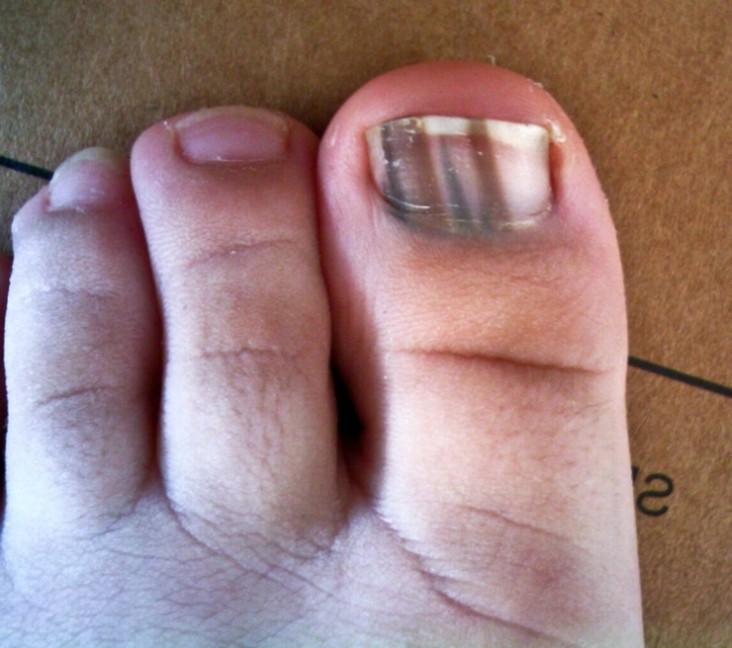 manejo de la melanoniquia 