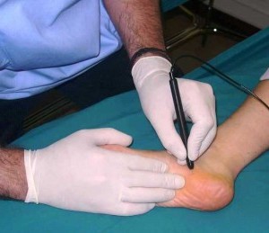 electrolisis percutanea intratisular manejo por podologo bogota